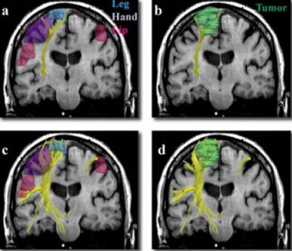 Characteristic Appearances and Differential Diagnosis of Meningioma