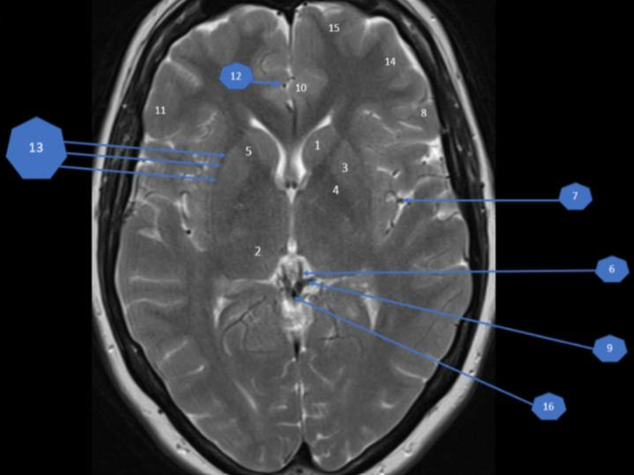 Normal Brain Anatomy on CT and MRI